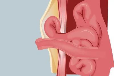 Graphic of a parastomal hernia