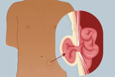 Graphic of a spigelian hernia