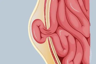 Graphic of a strangulated hernia