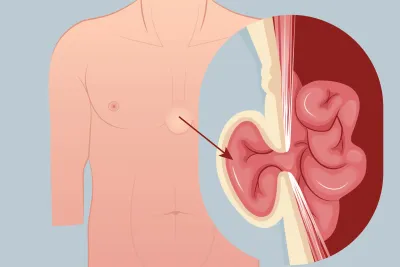 Graphic of a subxiphoid hernia