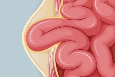 Graphic of an umbilical hernia