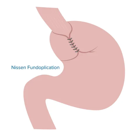 Graphic of a stomach with a Nissen Fundoplication procedure.