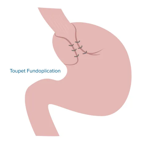 Graphic of a stomach with a Toupet Fundoplication procedure.