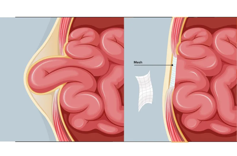 Graphic of an absorbable mesh to treat hernia