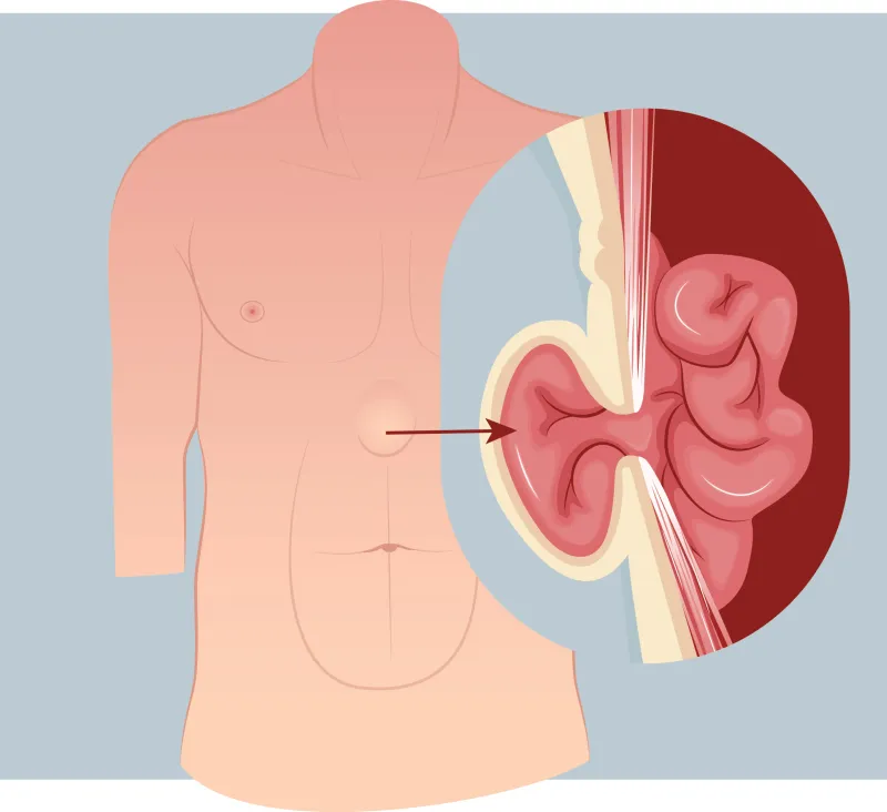 Graphic of an epigastric hernia
