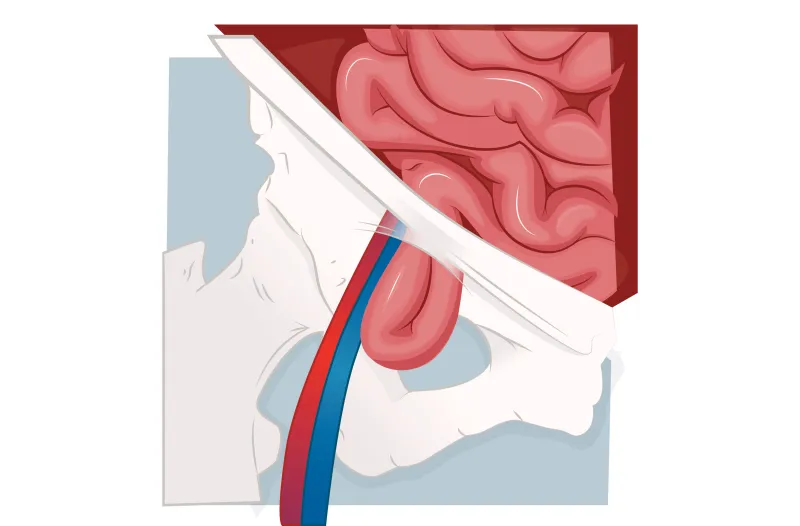 Graphic of a femoral hernia