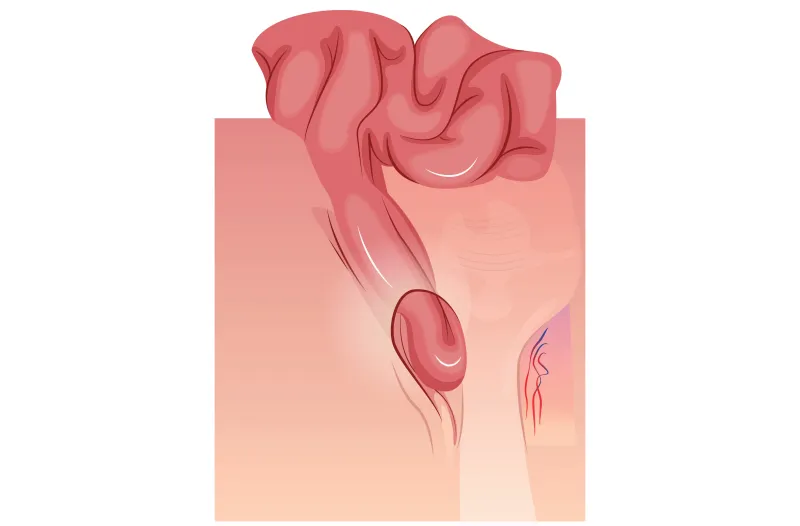Graphic of an inguinal hernia