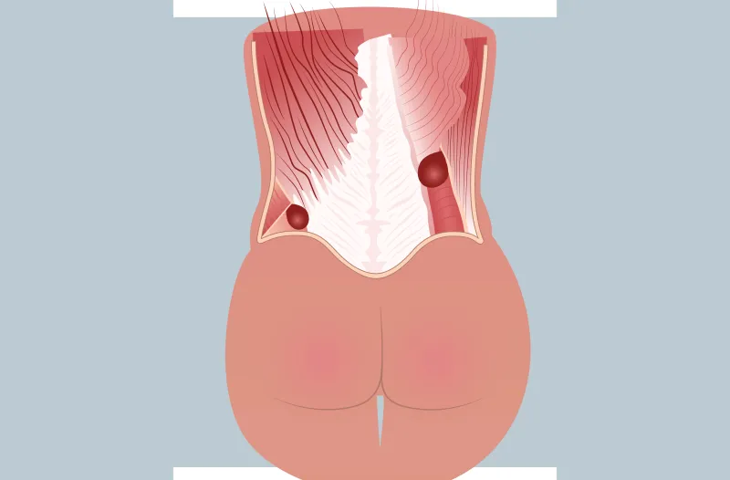 Graphic of a lumbar hernia