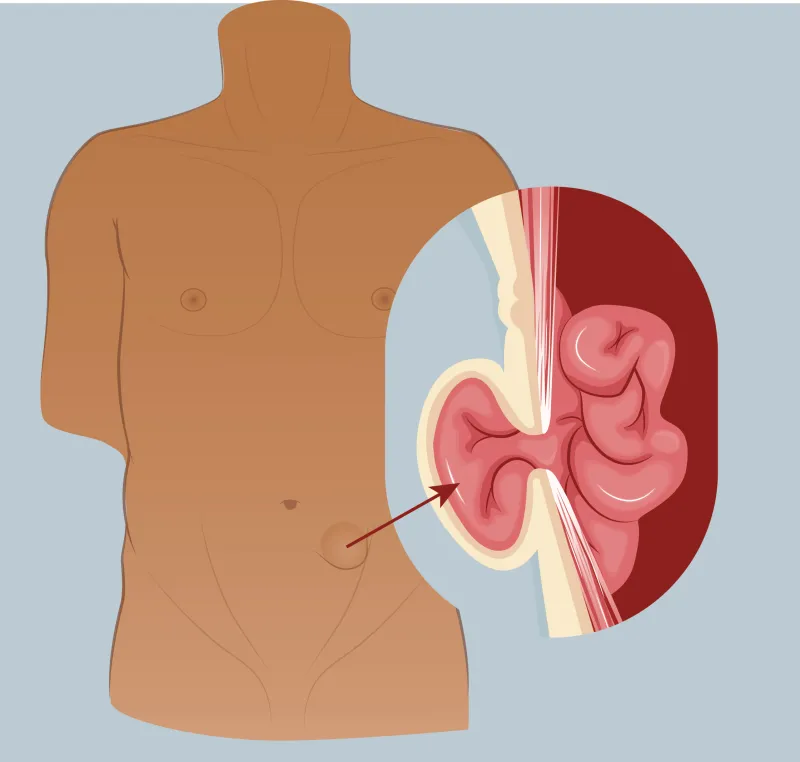 Graphic of a spigelian hernia