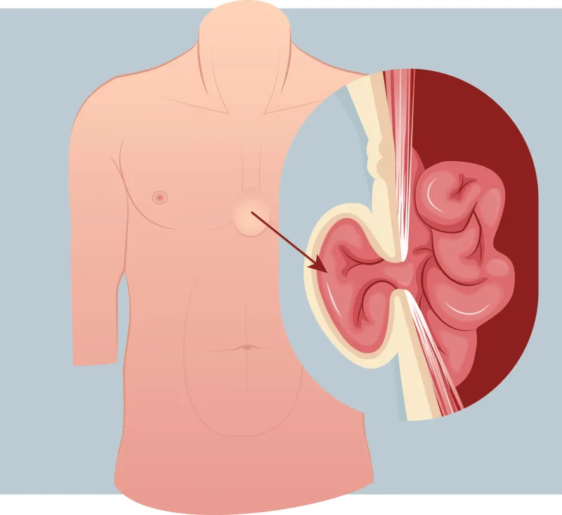 Graphic of a subxiphoid hernia