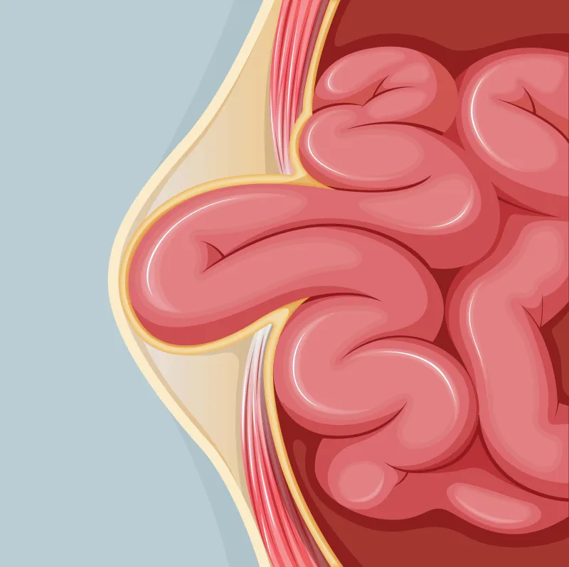 Graphic of an umbilical hernia